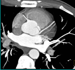 Normal Right Coronary Artery (RCA) - CTisus CT Scan