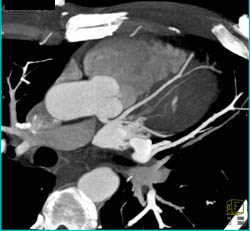 Normal Right Coronary Artery (RCA) - CTisus CT Scan