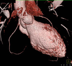 Normal Right Coronary Artery (RCA) - CTisus CT Scan