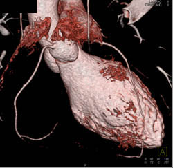 Normal Right Coronary Artery (RCA) - CTisus CT Scan