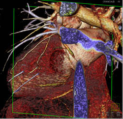 Normal Right Coronary Artery (RCA) - CTisus CT Scan