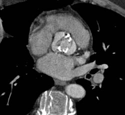 Calcified Bicuspid Valve - CTisus CT Scan