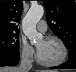 Calcified Bicuspid Valve - CTisus CT Scan