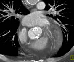 Calcified Bicuspid Valve - CTisus CT Scan