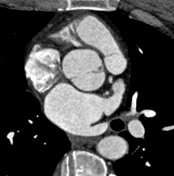 Bicuspid Valve - CTisus CT Scan