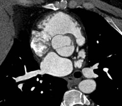 Bicuspid Valve - CTisus CT Scan