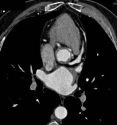 Aortic Valve Replacement (AVR) With Repair as Well as MVR - CTisus CT Scan