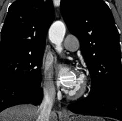 Aortic Valve Replacement (AVR) With Repair as Well as MVR - CTisus CT Scan