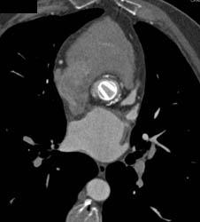 Aortic Valve Replacement (AVR) With Repair as Well as MVR - CTisus CT Scan