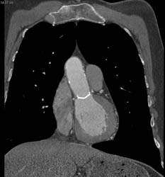 Aortic Valve Replacement (AVR) With Repair as Well as MVR - CTisus CT Scan