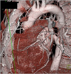 Aortic Valve Replacement (AVR) With Repair as Well as MVR - CTisus CT Scan