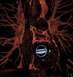 Aortic Valve Replacement (AVR) With Repair as Well as MVR - CTisus CT Scan