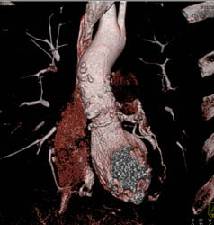 Aortic Valve Replacement (AVR) With Repair as Well as MVR - CTisus CT Scan