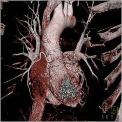 Aortic Valve Replacement (AVR) With Repair as Well as MVR - CTisus CT Scan