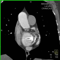 Aortic Valve Replacement (AVR) With Repair as Well as MVR - CTisus CT Scan