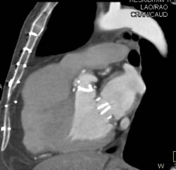 Aortic Valve Replacement (AVR) With Repair as Well as MVR - CTisus CT Scan