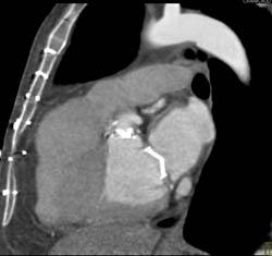 Aortic Valve Replacement (AVR) With Repair as Well as MVR - CTisus CT Scan