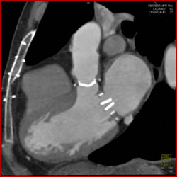 Aortic Valve Replacement (AVR) With Repair as Well as MVR - CTisus CT Scan