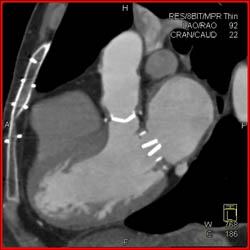 Aortic Valve Replacement (AVR) With Repair as Well as MVR - CTisus CT Scan