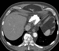 Calcified Pericardium and Constrictive Pericarditis - CTisus CT Scan