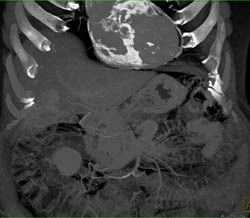 Calcified Pericardium and Constrictive Pericarditis - CTisus CT Scan