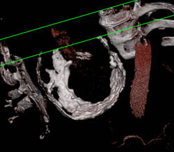 Calcified Pericardium and Constrictive Pericarditis - CTisus CT Scan