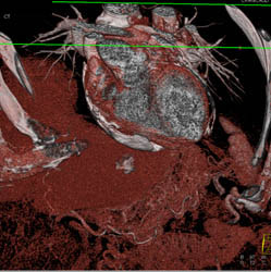 Calcified Pericardium and Constrictive Pericarditis - CTisus CT Scan