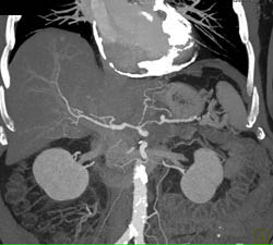 Calcified Pericardium and Constrictive Pericarditis - CTisus CT Scan