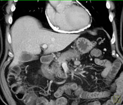 Calcified Pericardium and Constrictive Pericarditis - CTisus CT Scan