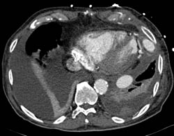 3D of Left Ventricular Assist Device (LVAD) Attachment to LV and Descending Aorta - CTisus CT Scan