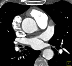 Pseudo-clot in Left Atrial Appendage - CTisus CT Scan