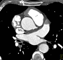 Pseudo-clot in Left Atrial Appendage - CTisus CT Scan