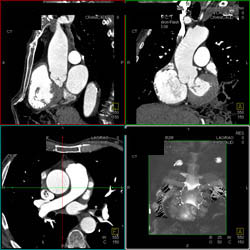 Pseudo-clot in Left Atrial Appendage - CTisus CT Scan