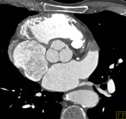 Pseudo-clot in Left Atrial Appendage - CTisus CT Scan