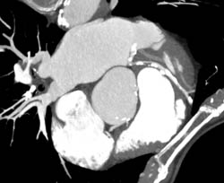 50% Stenosis in Left Anterior Descending Coronary Artery (LAD) - CTisus CT Scan