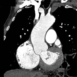 Dilated Aortic Root - CTisus CT Scan