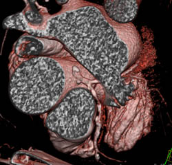 Left Anterior Descending Coronary Artery (LAD) Disease - CTisus CT Scan