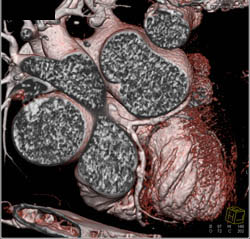 Left Anterior Descending Coronary Artery (LAD) Disease - CTisus CT Scan