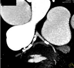 Left Anterior Descending Coronary Artery (LAD) Disease - CTisus CT Scan