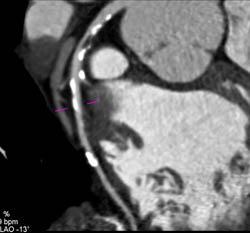 Left Anterior Descending Coronary Artery (LAD) Disease - CTisus CT Scan