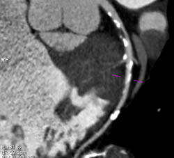 Left Anterior Descending Coronary Artery (LAD) Disease - CTisus CT Scan