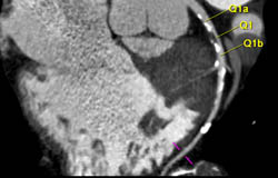 Left Anterior Descending Coronary Artery (LAD) Disease - CTisus CT Scan