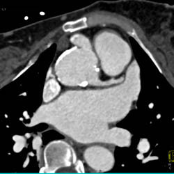 Dilated Right Coronary Artery (RCA) At Re-implantation Site - CTisus CT Scan