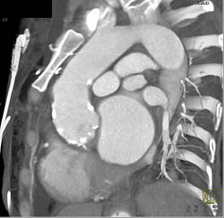 Dilated Right Coronary Artery (RCA) At Re-implantation Site - CTisus CT Scan