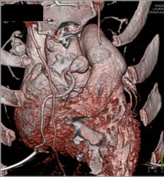 Dilated Right Coronary Artery (RCA) At Re-implantation Site - CTisus CT Scan