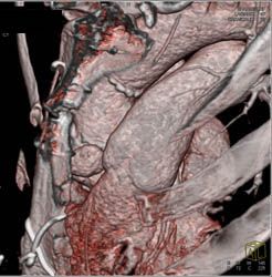 Dilated Right Coronary Artery (RCA) At Re-implantation Site - CTisus CT Scan