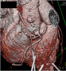 Dilated Right Coronary Artery (RCA) At Re-implantation Site - CTisus CT Scan