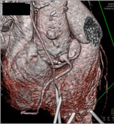 Dilated Right Coronary Artery (RCA) At Re-implantation Site - CTisus CT Scan