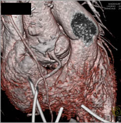 Dilated Right Coronary Artery (RCA) At Re-implantation Site - CTisus CT Scan