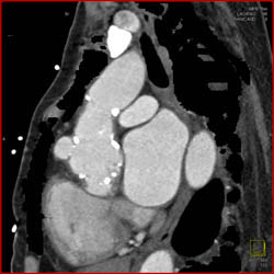 Dilated Right Coronary Artery (RCA) At Re-implantation Site - CTisus CT Scan